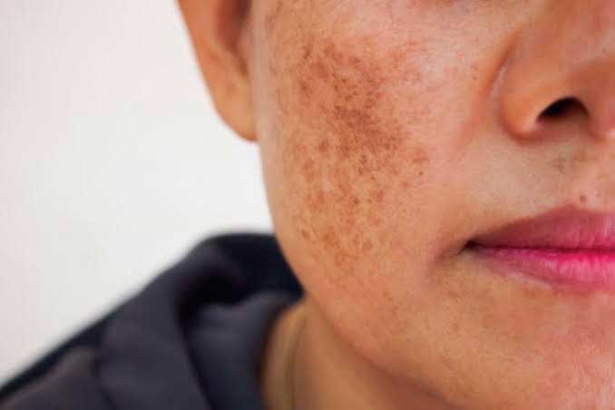 melasma e mancha